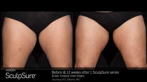 Before & 12 Weeks After 1 SculpSure Treatments On Legs