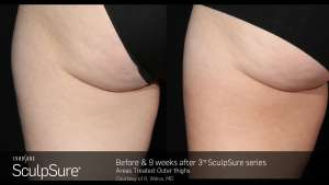 Before & 9 Weeks After 3 SculpSure Treatments On Thighs