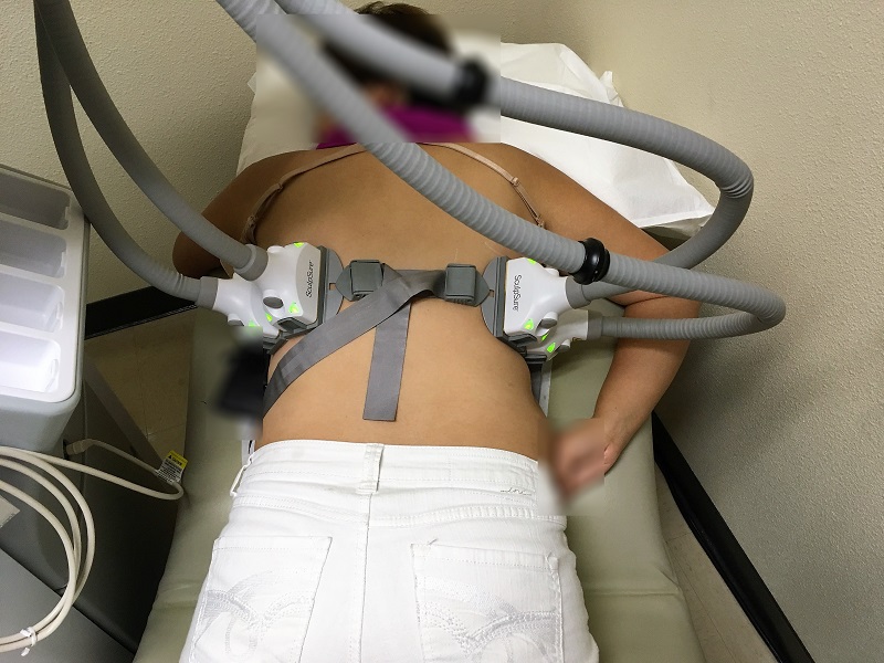 sculpsure for the lower and upper back